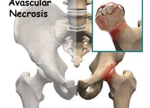 Femur Basi Avaskuler Nekrozu Avn