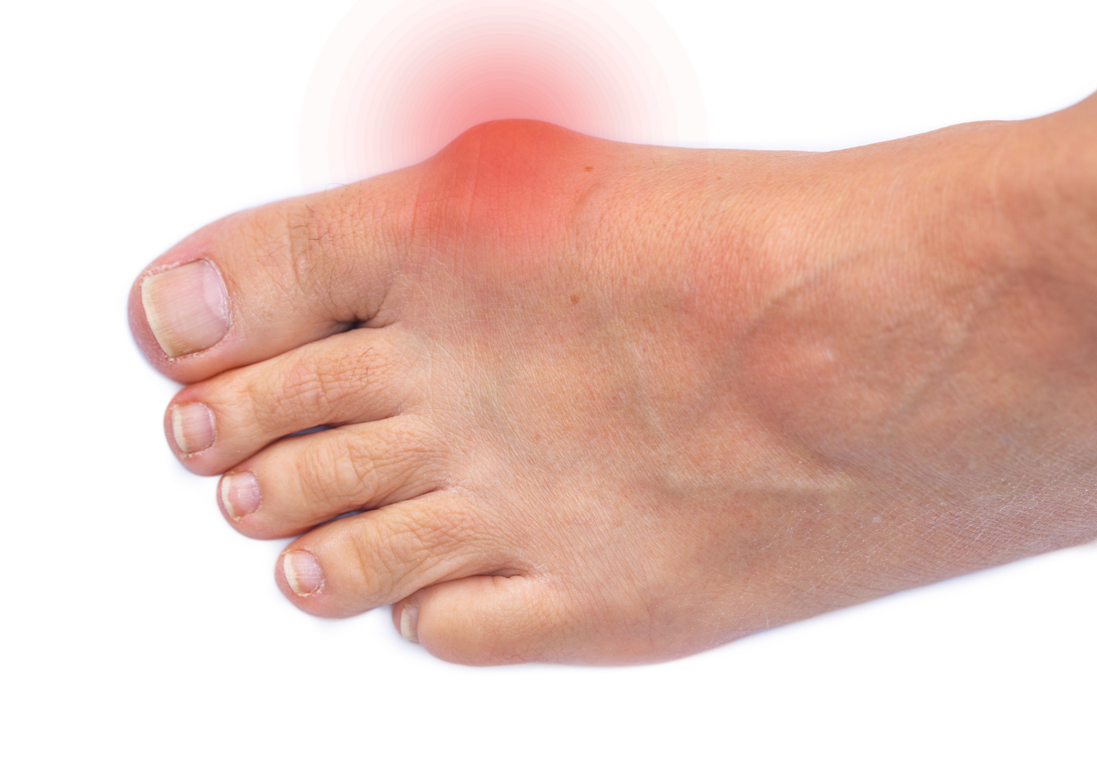 Halluks Valgus Hallux Valgus Nedir