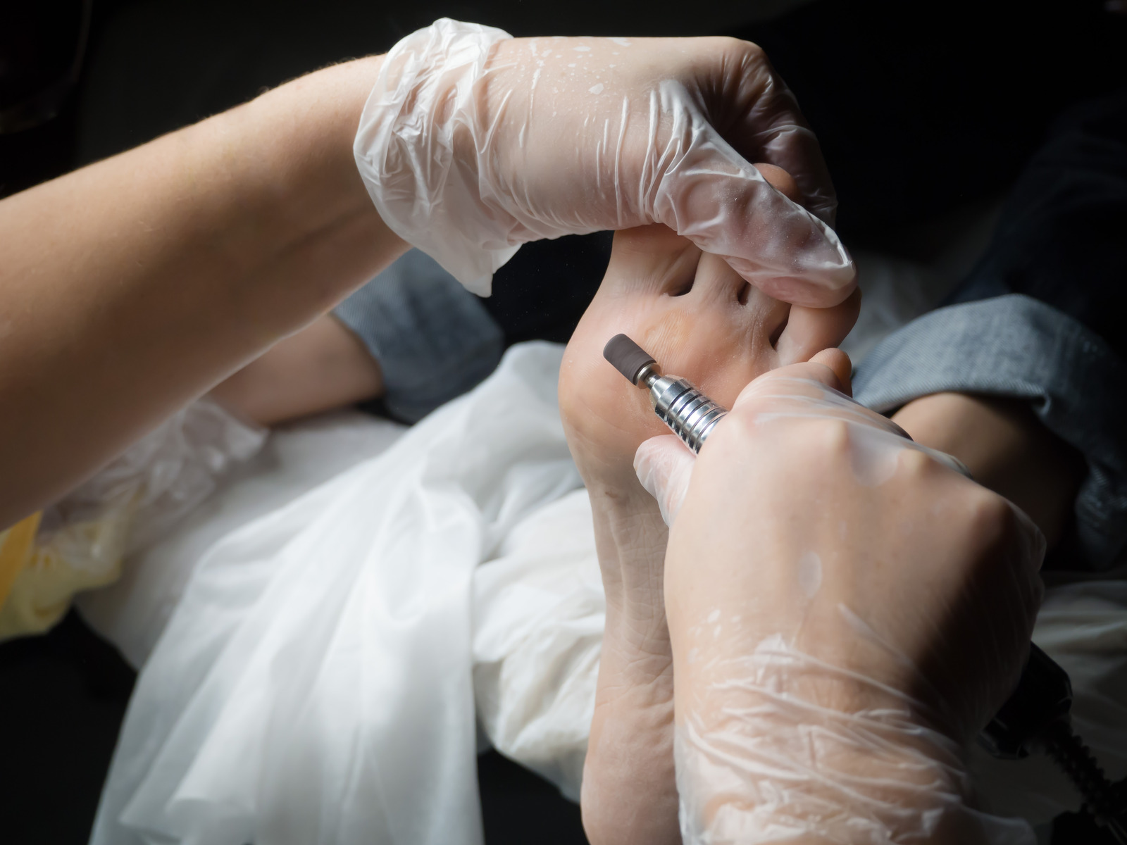 Sindirella Cerrahisi Cinderella Surgery Ayak Estetigi Nedir